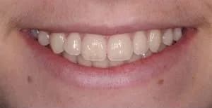 Rehabilitación estética: comparación de la sonrisa antes y después — antes