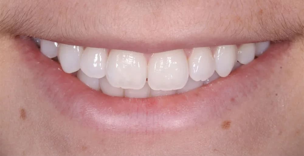 Rehabilitación estética: comparación de la sonrisa antes y después — después