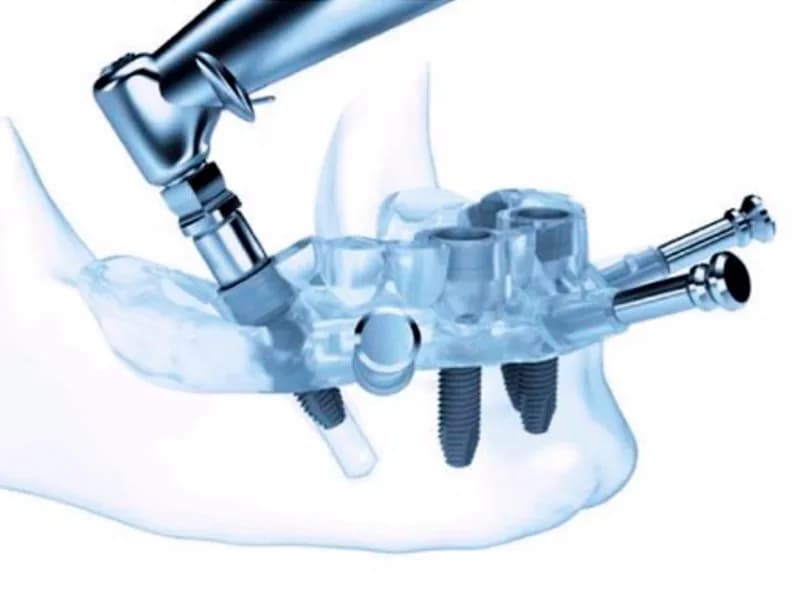 Férula de cirugía guiada para la colocación de implantes