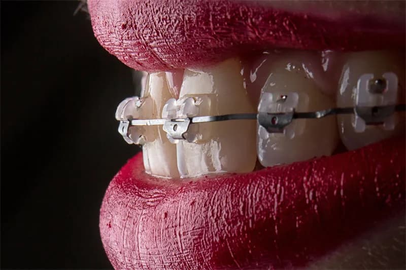 Brackets estéticos de zafiro colocados